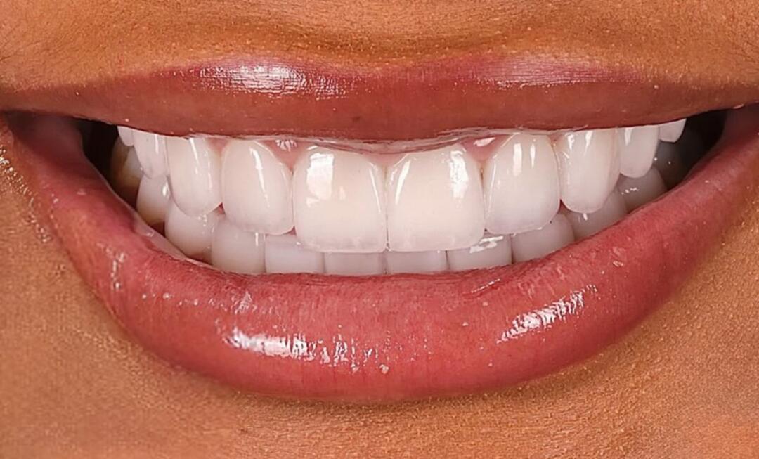 Teeth Whitening