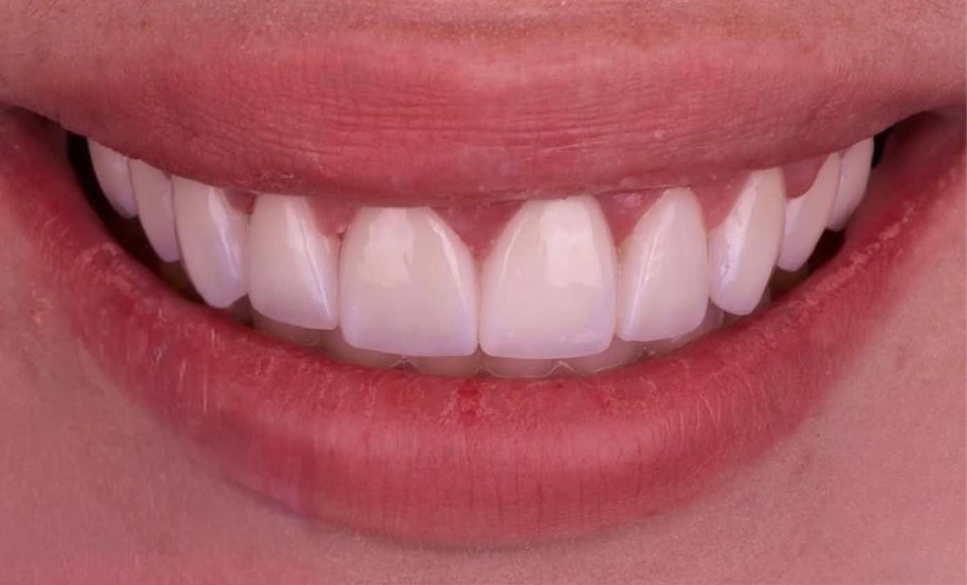 Dental Bridge (per tooth)